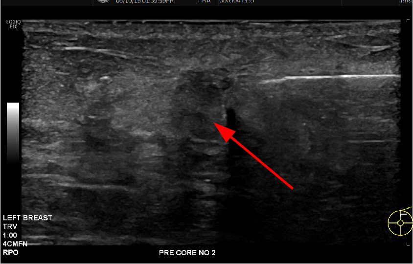 Breast biopsy